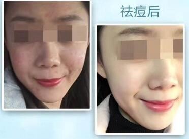 张瓈涓