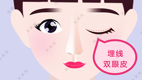 埋线双眼皮手术的优点是什么？