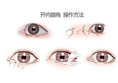 开内眼角手术