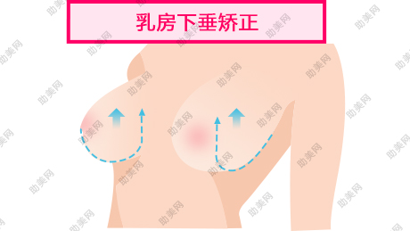 乳房下垂矫正术的方法有哪些呢？