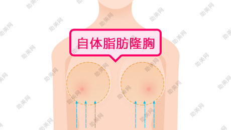 自体脂肪隆胸手术后该怎么护理