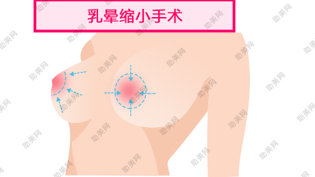 现代女子乳晕漂红效果自然吗