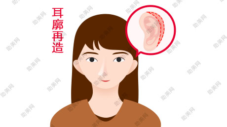 晴颜耳再造价格跟材料有关吗