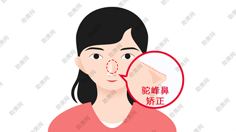 广州华医驼峰鼻矫正切口在哪