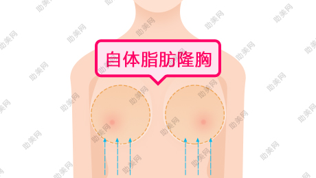 武汉美都自体脂肪隆胸的副作用