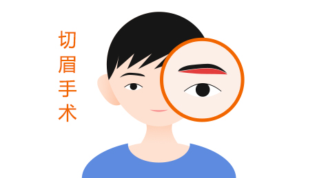 切眉术的手术效果是怎样的