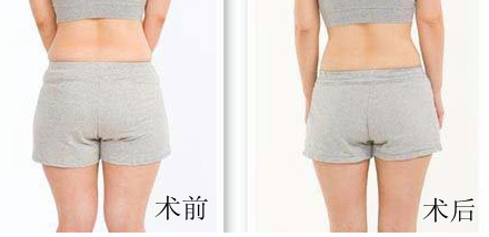 臀部吸脂