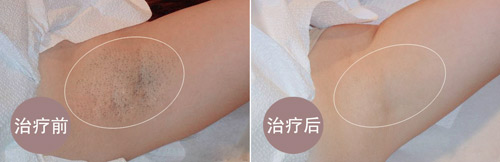 去除腋毛对比