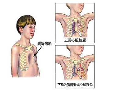 漏斗胸