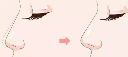 短鼻可以矫正吗？