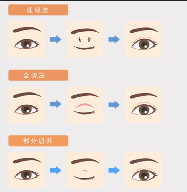 双眼皮类型
