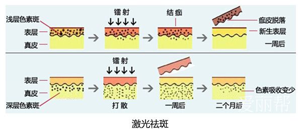 激光祛斑.jpg