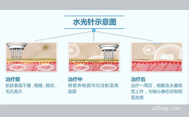 水光针示意图.jpg